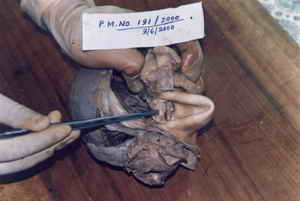 Figure 1: Heart showing the aortic valves which are calcified and fused reducing the aortic opening into a narrow slit