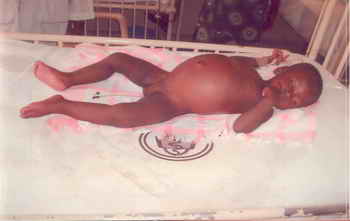 Figure 1: Case showing generalized erythema with abdominal distension on day 1