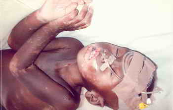 Figure 2: Same patient (as in figure 1) with desquamation, extensive epidermolysis and weight loss