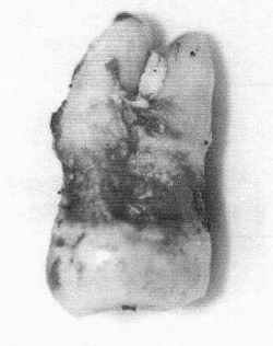 A tooth used in a forensic criminal investigation