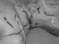 Several incised wounds as well as stab wounds of the neck and thorax that were attributed to an assault by a knife and to glass splinters from the broken bottle.