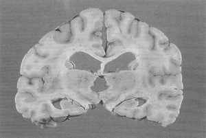 Marked hydrocephalus as a result of prior to death undiagnosed astrocytoma of the brainsten in a 29 year old man showing massive enlargement of the cerebral ventricles including temporal horns of the lateral ventricle and the third ventricle