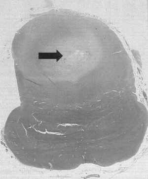 Pilocytic astrocytoma of the ponto-mesencephalic junction with blurring of original parenchymal structures and occluding the aqueduct (arrow) leading to occlusive hydrocephalus