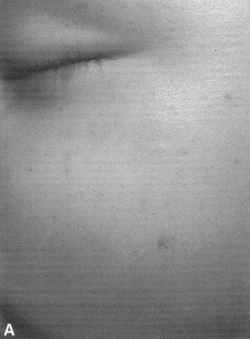 Discrete facial petechiae