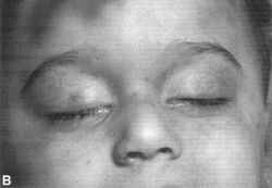 Marked petechial hemorrhages in the skin of the eyelids