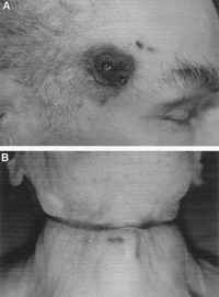 Fig. 1. Planned complex suicide of a 72-year-old man by shot to the head with a modified blank cartridge revolver and hanging. (A) Entrance wound on right temple. (B) Hanging mark