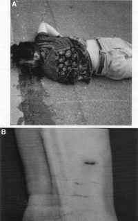 Fig. 1. Planned complex suicide of a 72-year-old man by shot to the head with a modified blank cartridge revolver and hanging. (A) Entrance wound on right temple. (B) Hanging mark