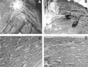 Subendocardial hemorrhages