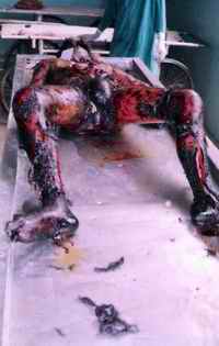 Figure 3: The deceased lying on the autopsy table. Notice burn like effect over both lower limbs.