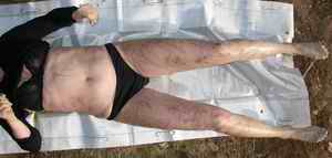 Figure 1. Body of the woman after recovery: striated reddening of the skin and hematoma marks, particularly on the anterior aspects of the thighs