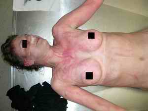 Figure 2. Striated reddening of the skin on the chest up to the neck, no hematoma marks; fungus on the nose.