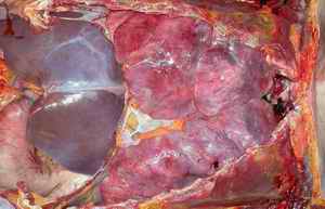 Figure 3. Post-mortem state of the woman with markedly inflated lungs.