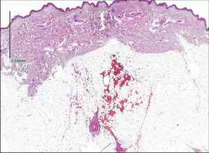 Figure 4.Narrow striated reddening in the skin form the chest; isolated subcutaneous hematoma (H & E stain)