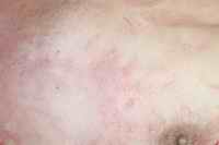 Figure 3. Photographs at completion of post mortem examination, approx 24 hours post mortem, demonstrate only trace erythema.