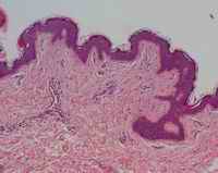 Figure 5. Microscopic sections of skin show normal histology with rare perivascular extravasation of red blood cells.