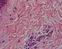 Figure 6. Microscopic sections of skin show normal histology with rare perivascular extravasation of red blood cells.