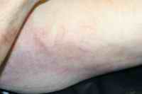 Figure 7. Lichtenberg Flowers on the sides of the torso.