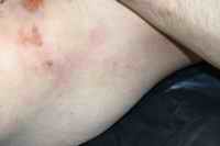 Figure 8. Lichtenberg Flowers on the sides of the torso.