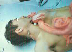 Figure 3. This picture shows discontinuity on the right lateral aspect of neck at the site of knot in case of suicidal hanging