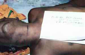 Figure 5. This picture shows discontinuity of ligature mark on the anterolateral aspects of neck (on both sides) in case of homicidal hanging