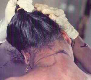 Figure 6. This picture shows continuous and overriding  ligature mark at the back of neck in a case of ligature strangulation