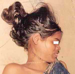 Figure 7. Figure showing oblique ligature mark in case of suicidal hanging