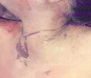 Figure 10. This picture shows a case of ligature strangulation where ligature mark appears to be oblique, due to use of very hard ligature like metallic wire. Otherwise it was horizontal around the neck