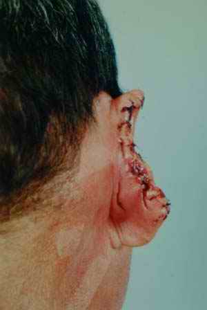 Photograph showing biting injury to right ear after medical intervention - from A Physicians Guide to Clinical Forensic Medicine, 2nd edition. Includes eBook/PDA on CD-ROM. Edited by Margaret M Stark