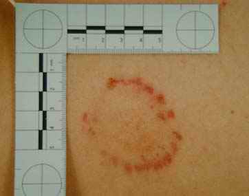 Photograph showing bite mark on back, with scales. Individual tooth detail is visible - from A Physicians Guide to Clinical Forensic Medicine, 2nd edition. Includes eBook/PDA on CD-ROM. Edited by Margaret M Stark