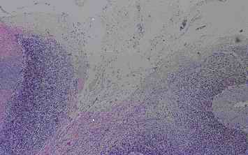 Fig. 1. Old infarct area in the cerebellum from an individual (autopsy no.0636).
Reticulation made by collagen-like fibers exist in the intact cortex by HE stain (1-A). Anti CC clearly stains the collagen-like fibers like as the meshes of a net (1-B). Although anti PSA weakly stained the collagen-like fibers, anti PGDS showed no reactivity with the collagen-like fibers