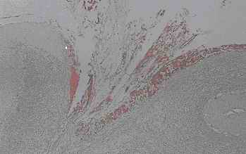 Fig. 1. Old infarct area in the cerebellum from an individual (autopsy no.0636).
Reticulation made by collagen-like fibers exist in the intact cortex by HE stain (1-A). Anti CC clearly stains the collagen-like fibers like as the meshes of a net (1-B). Although anti PSA weakly stained the collagen-like fibers, anti PGDS showed no reactivity with the collagen-like fibers