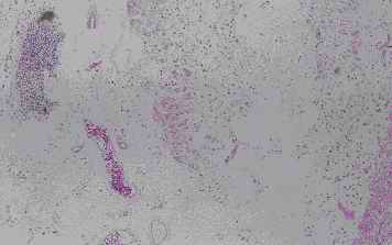 Fig. 2. Old infarct area in the cerebellum from an individual (autopsy no.0636). Amorphous material without nucleus was recognized adjacent to the granular cell layer and the collagen-like fibers are found between the amorphous materials by HE stain (2-A). Anti CC clearly and intensively stains the amorphous material and collagen-like fibers (2-B). Although anti PSA weakly stained the amorphous material, anti CB and anti PGDS showed feeble reactivity