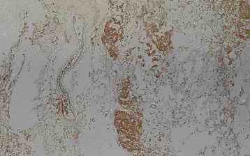 Fig. 2. Old infarct area in the cerebellum from an individual (autopsy no.0636). Amorphous material without nucleus was recognized adjacent to the granular cell layer and the collagen-like fibers are found between the amorphous materials by HE stain (2-A). Anti CC clearly and intensively stains the amorphous material and collagen-like fibers (2-B). Although anti PSA weakly stained the amorphous material, anti CB and anti PGDS showed feeble reactivity
