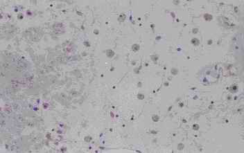 Figure 3. Old infarct area in the cerebellum from an individual (autopsy no.0636). 
Small vessels, capillaries, are increased and numerous macrophage-like cells infiltrate in to the center of the infracted area. Amorphous materials also exist in the center by HE stain like as islands (3-A).  Anti CC stains the amorphous material and shows weak reactivity with macrophage-like cells (3-B). The macrophage-like cells are intensively stained by anti CB (3-C). Anti PSA and anti PGDS show weak reactivity with the macrophage-like cells