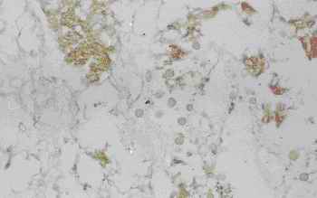 Figure 3. Old infarct area in the cerebellum from an individual (autopsy no.0636). 
Small vessels, capillaries, are increased and numerous macrophage-like cells infiltrate in to the center of the infracted area. Amorphous materials also exist in the center by HE stain like as islands (3-A).  Anti CC stains the amorphous material and shows weak reactivity with macrophage-like cells (3-B). The macrophage-like cells are intensively stained by anti CB (3-C). Anti PSA and anti PGDS show weak reactivity with the macrophage-like cells