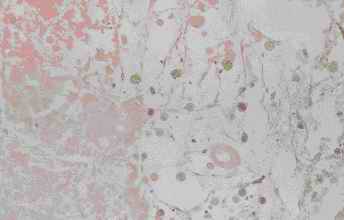 Figure 3. Old infarct area in the cerebellum from an individual (autopsy no.0636). 
Small vessels, capillaries, are increased and numerous macrophage-like cells infiltrate in to the center of the infracted area. Amorphous materials also exist in the center by HE stain like as islands (3-A).  Anti CC stains the amorphous material and shows weak reactivity with macrophage-like cells (3-B). The macrophage-like cells are intensively stained by anti CB (3-C). Anti PSA and anti PGDS show weak reactivity with the macrophage-like cells