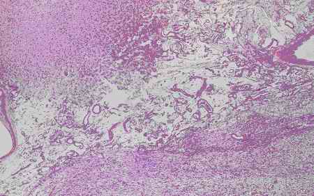 Figure 4. Relatively-old infarct area in the cerebrum from an individual (autopsy no.50947). Numerous small sized glial cells and capillaries exist in the cavity due to necrosis after infarction by HE stain and show no reactivity with these antibodies used in this study