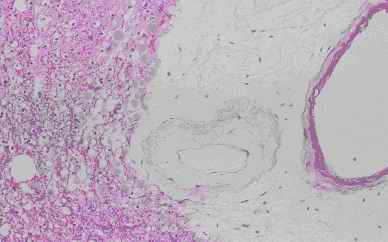 Figure 5. Immunostaining of corpora amylacea in the cerebrum from an individual (autopsy no.50947). Many corpora amylacea are detected around a blood vessel that exist the surrounding the infracted cavity (5-A). The corpora amylacea show intensive reactivity with CB (5-B), weak with PSA (5-C), feeble with CC (5-D) and PGDS (5-E)