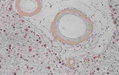 Figure 5. Immunostaining of corpora amylacea in the cerebrum from an individual (autopsy no.50947). Many corpora amylacea are detected around a blood vessel that exist the surrounding the infracted cavity (5-A). The corpora amylacea show intensive reactivity with CB (5-B), weak with PSA (5-C), feeble with CC (5-D) and PGDS (5-E)