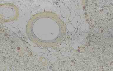 Figure 5. Immunostaining of corpora amylacea in the cerebrum from an individual (autopsy no.50947). Many corpora amylacea are detected around a blood vessel that exist the surrounding the infracted cavity (5-A). The corpora amylacea show intensive reactivity with CB (5-B), weak with PSA (5-C), feeble with CC (5-D) and PGDS (5-E)