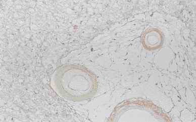 Figure 5. Immunostaining of corpora amylacea in the cerebrum from an individual (autopsy no.50947). Many corpora amylacea are detected around a blood vessel that exist the surrounding the infracted cavity (5-A). The corpora amylacea show intensive reactivity with CB (5-B), weak with PSA (5-C), feeble with CC (5-D) and PGDS (5-E)