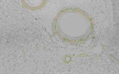 Figure 5. Immunostaining of corpora amylacea in the cerebrum from an individual (autopsy no.50947). Many corpora amylacea are detected around a blood vessel that exist the surrounding the infracted cavity (5-A). The corpora amylacea show intensive reactivity with CB (5-B), weak with PSA (5-C), feeble with CC (5-D) and PGDS (5-E)