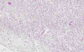 Figure 6. Relatively-old infarct area in the cerebrum from an individual (autopsy no.50947). 
Germistocytic astrocytes, large sized astrocytes, are detected in the cortex, peripheral area of the cavity, by HE stain (6-A). The astrocytes show relatively good reactivity with anti CC (6-B), CB (6-C), PGDS (6-D) and PSA (6-E), respectively