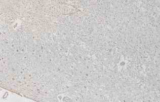 Figure 6. Relatively-old infarct area in the cerebrum from an individual (autopsy no.50947). 
Germistocytic astrocytes, large sized astrocytes, are detected in the cortex, peripheral area of the cavity, by HE stain (6-A). The astrocytes show relatively good reactivity with anti CC (6-B), CB (6-C), PGDS (6-D) and PSA (6-E), respectively