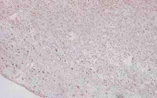 Figure 6. Relatively-old infarct area in the cerebrum from an individual (autopsy no.50947). 
Germistocytic astrocytes, large sized astrocytes, are detected in the cortex, peripheral area of the cavity, by HE stain (6-A). The astrocytes show relatively good reactivity with anti CC (6-B), CB (6-C), PGDS (6-D) and PSA (6-E), respectively