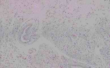 Figure 7. Old infract area of vassal ganglia from an individual (autopsy no. 0544). The germistocytic astrocytes detected in the center of the infarction by HE (7-A) are clearly and intensively stained by anti CC (7-B), CB (7-C) and PGDS (7-D), and weak by anti-PSA (7-E), respectively