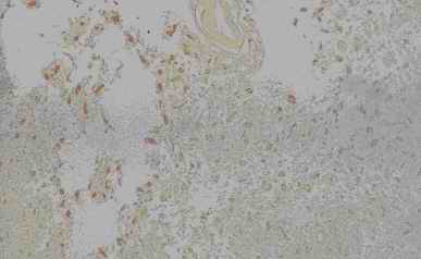 Figure 7. Old infract area of vassal ganglia from an individual (autopsy no. 0544). The germistocytic astrocytes detected in the center of the infarction by HE (7-A) are clearly and intensively stained by anti CC (7-B), CB (7-C) and PGDS (7-D), and weak by anti-PSA (7-E), respectively