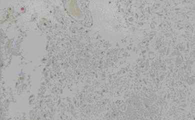 Figure 7. Old infract area of vassal ganglia from an individual (autopsy no. 0544). The germistocytic astrocytes detected in the center of the infarction by HE (7-A) are clearly and intensively stained by anti CC (7-B), CB (7-C) and PGDS (7-D), and weak by anti-PSA (7-E), respectively