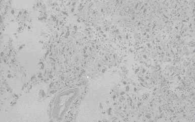 Figure 7. Old infract area of vassal ganglia from an individual (autopsy no. 0544). The germistocytic astrocytes detected in the center of the infarction by HE (7-A) are clearly and intensively stained by anti CC (7-B), CB (7-C) and PGDS (7-D), and weak by anti-PSA (7-E), respectively