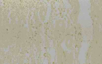 Figure 8. Old infract area of vassal ganglia from an individual (autopsy no. 0544). Macrophages were stained intensively by anti CB (8-A), moderately by anti-PGDS (8-B) and CC (8-C), and weakly by anti-PSA (8-D)
